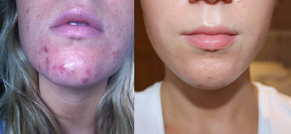 Why you Need To Treat Your Acne NOW!
