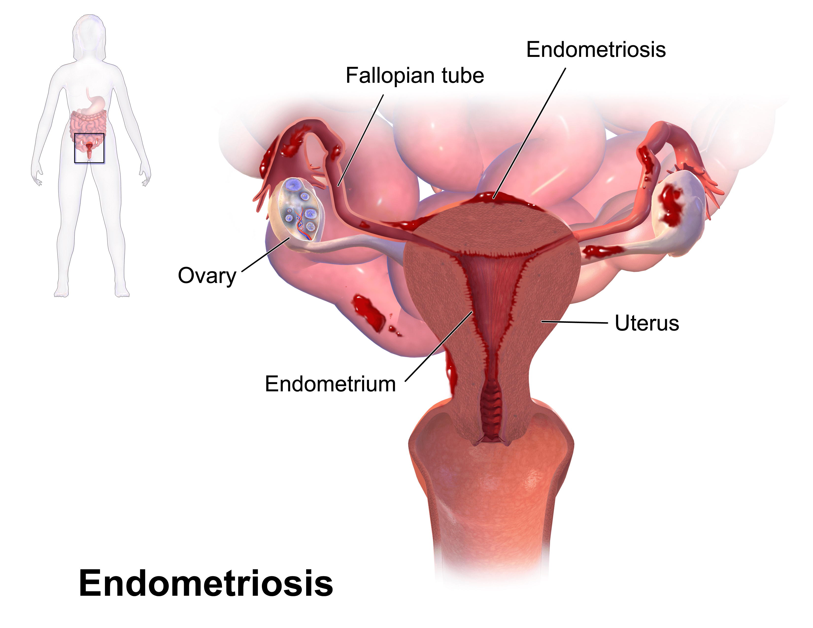 consult Endocrinologist for Endometriosis