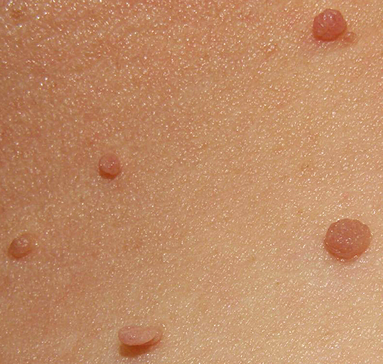 Why do Skin Tags Grow during Pregnancy?