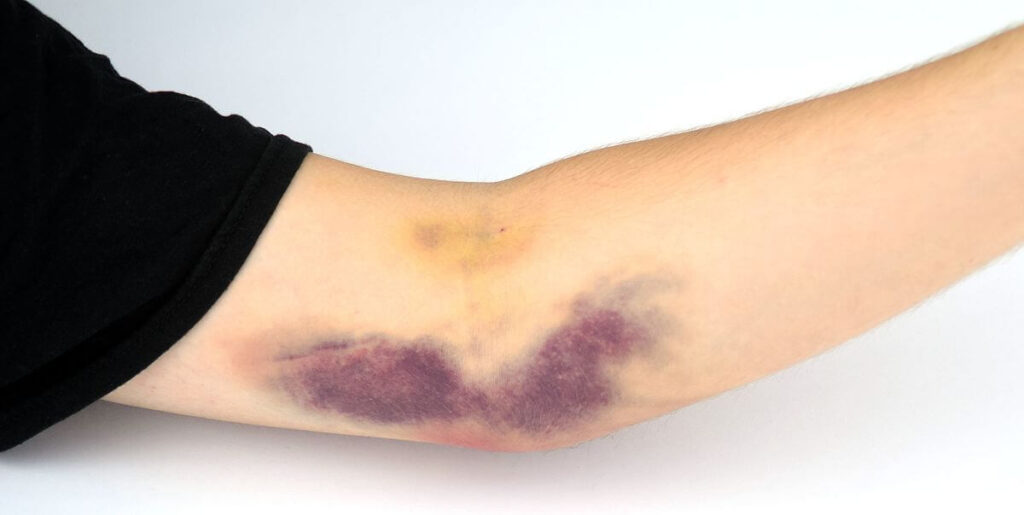 Ways to treat your Hematoma problem naturally